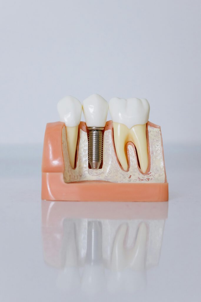 pexels-photo-6502306-6502306 Detailed view of a dental implant model showcasing teeth and gum anatomy for dental education.